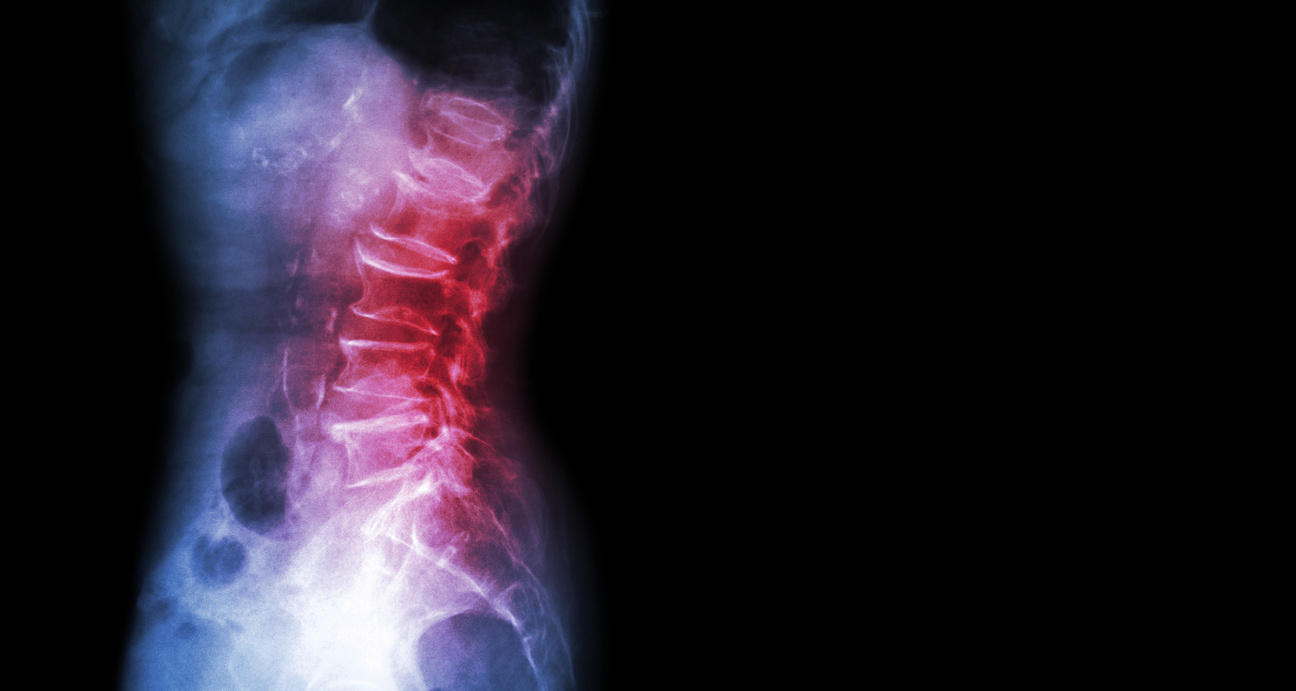 chronic back pain
