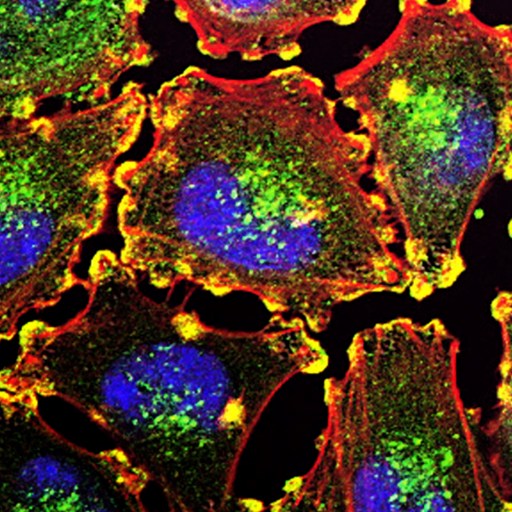 Metastatic Melanoma Cells