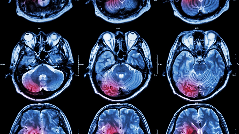 post-stroke dementia
