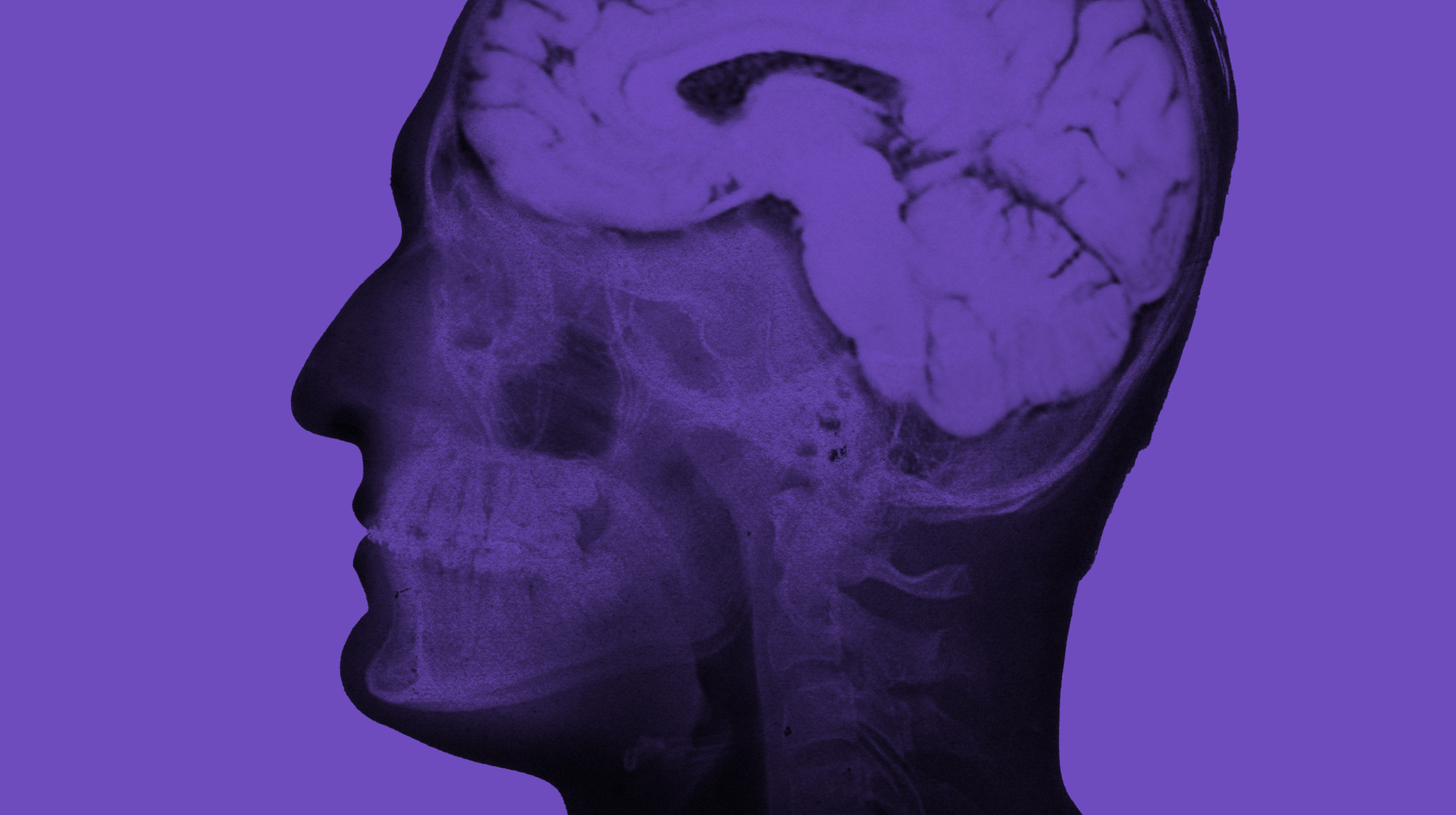 Side view X-ray image of a human head and brain in shades of purple, shown against a solid purple background, highlighting the serene focus often seen in meditators.