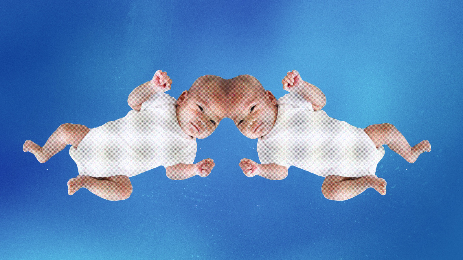 conjoined twins