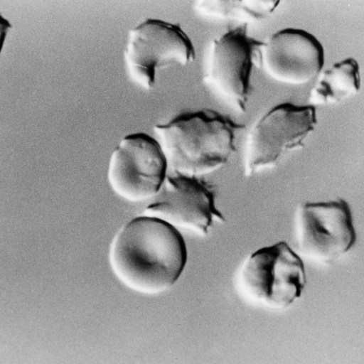 A black and white photo of a black and white photo illustrating the potential of CRISPR technology to treat sickle cell disease.
