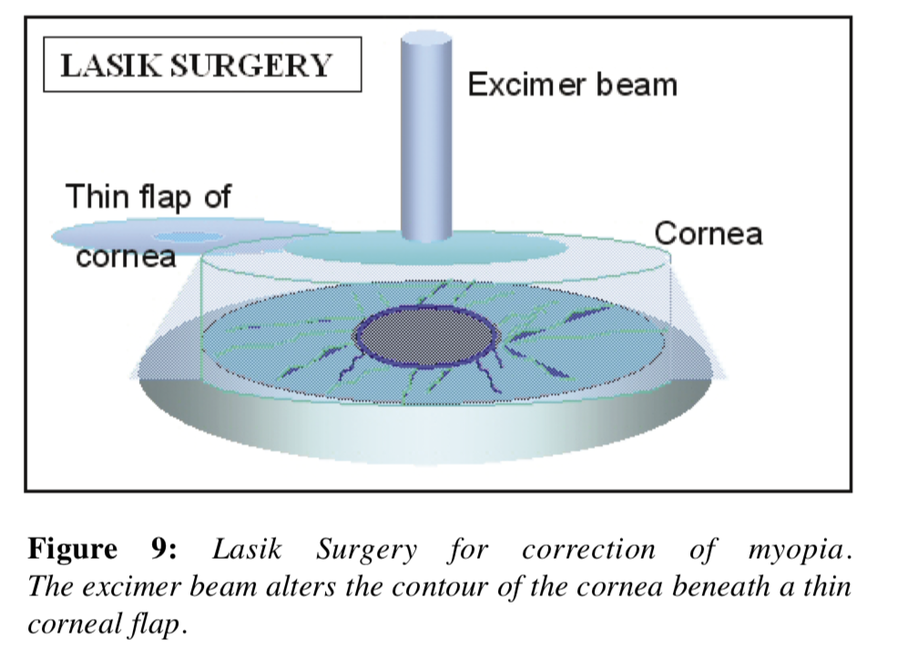 Diagram of LASIK surgery illustrating the science of LASIK, with an excimer beam reshaping the cornea beneath a thin flap to correct myopia.