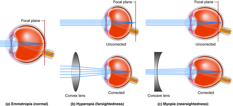 Diagram showing normal vision, hyperopia corrected with a convex lens, and myopia corrected with a concave lens, illustrating how light focuses on the retina&mdash;principles foundational to the science of LASIK.