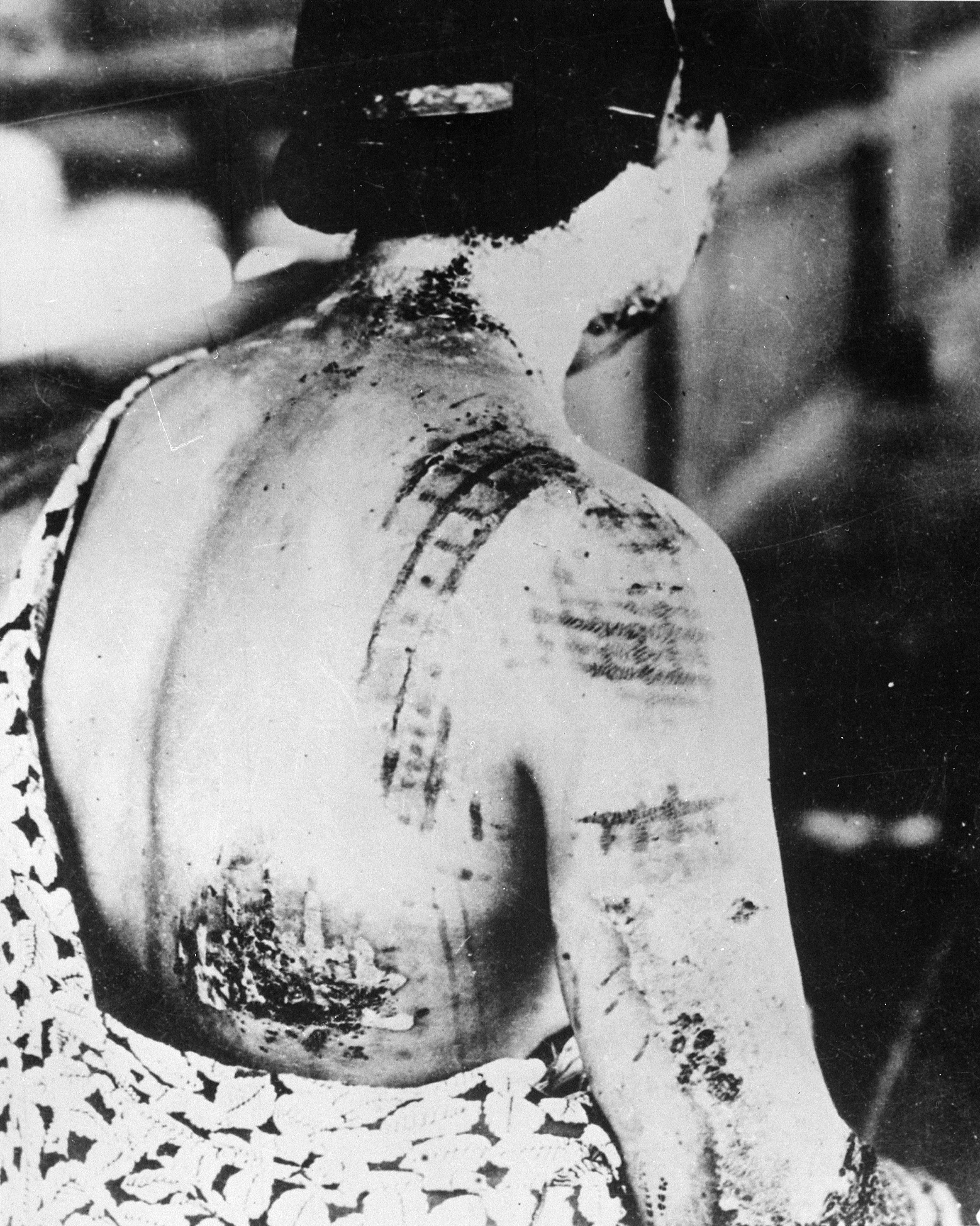 A person with severe burns and scar patterns on their back and shoulder, likely caused by exposure to intense heat or radiation.