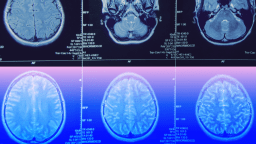 Six brain MRI scan images are arranged in two rows, showing various cross-sectional views of the human brain, with the bottom row featuring a blue and pink color overlay.
