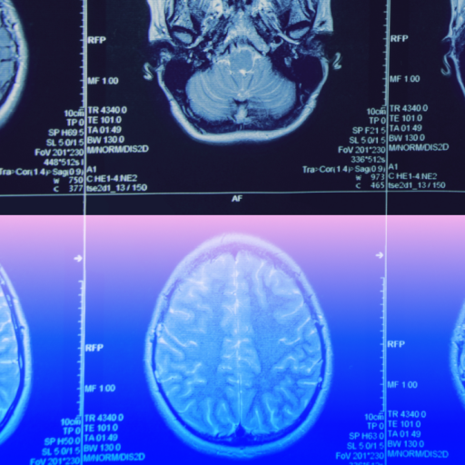 Six brain MRI scan images are arranged in two rows, showing various cross-sectional views of the human brain, with the bottom row featuring a blue and pink color overlay.